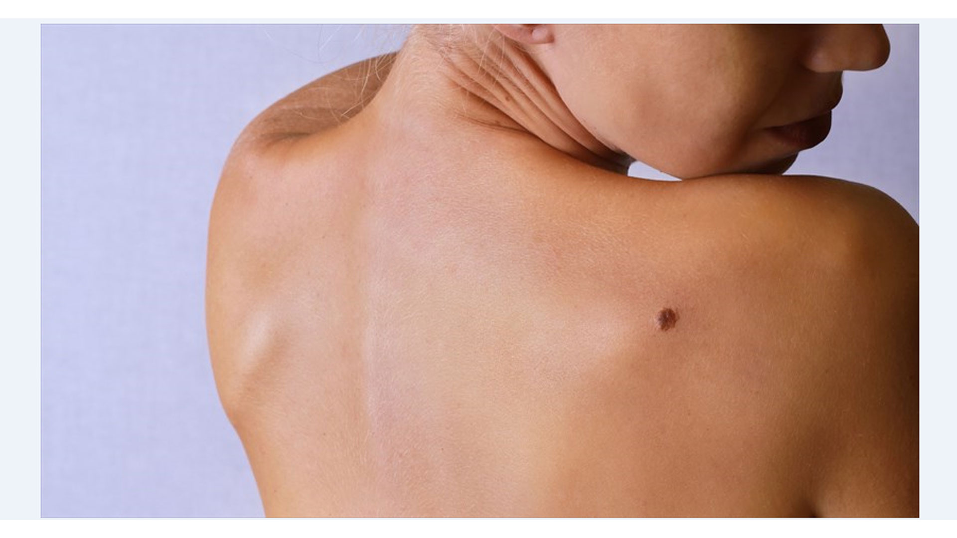 melanoma
