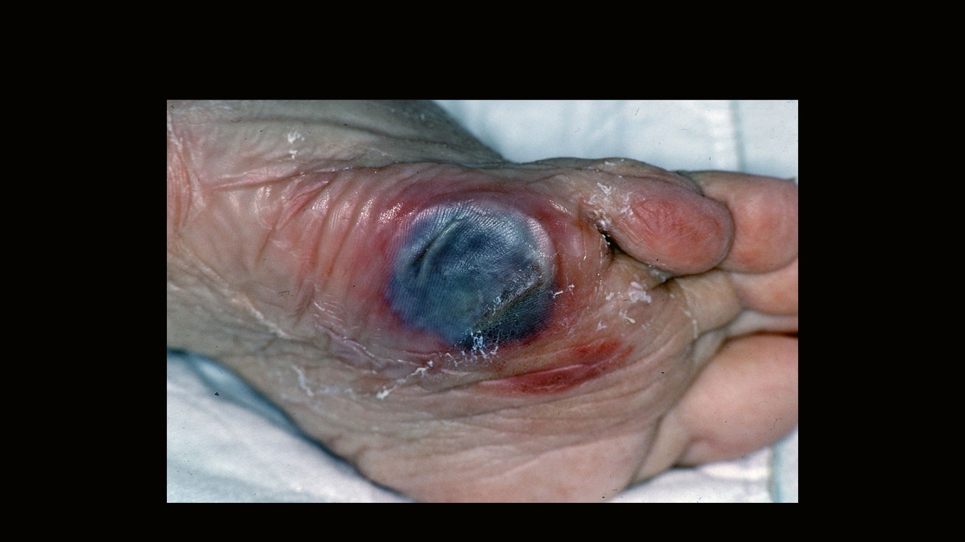 pressure ulcer