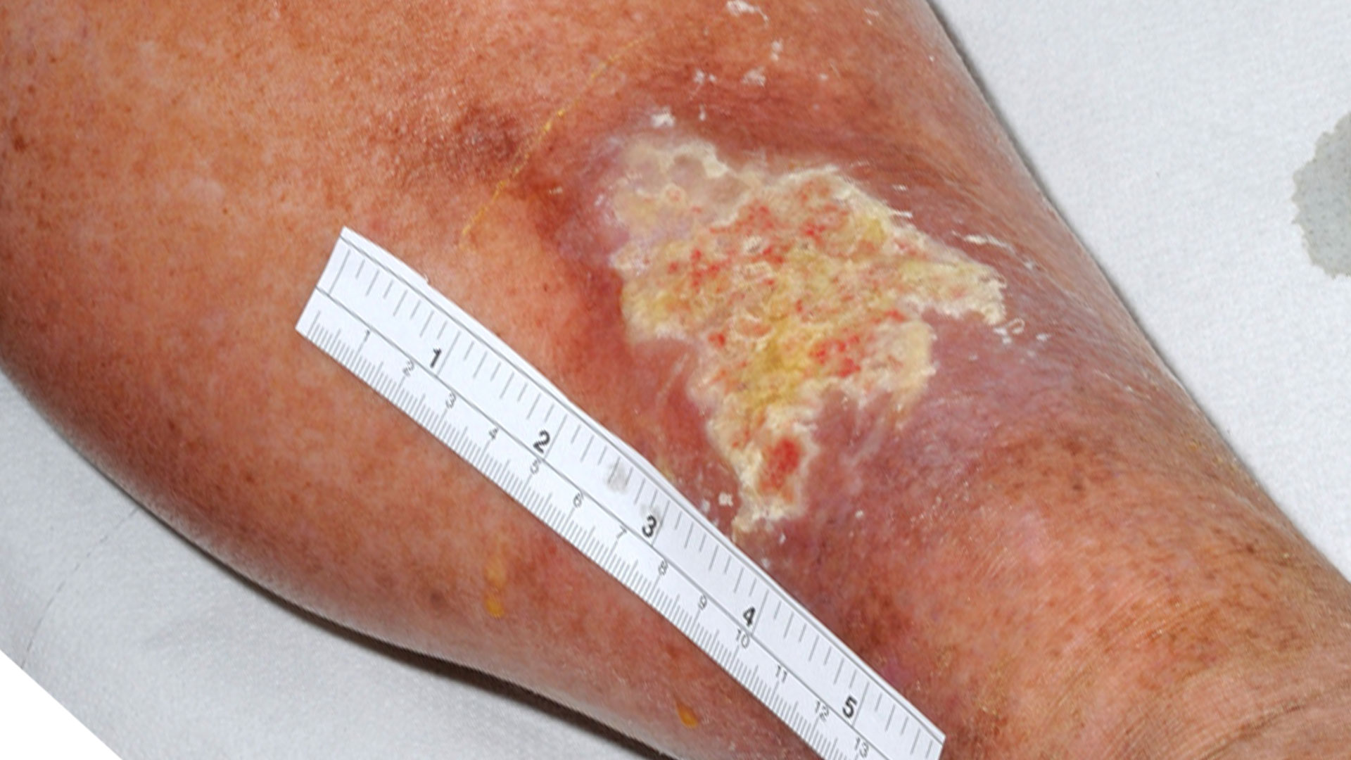a wound on a leg