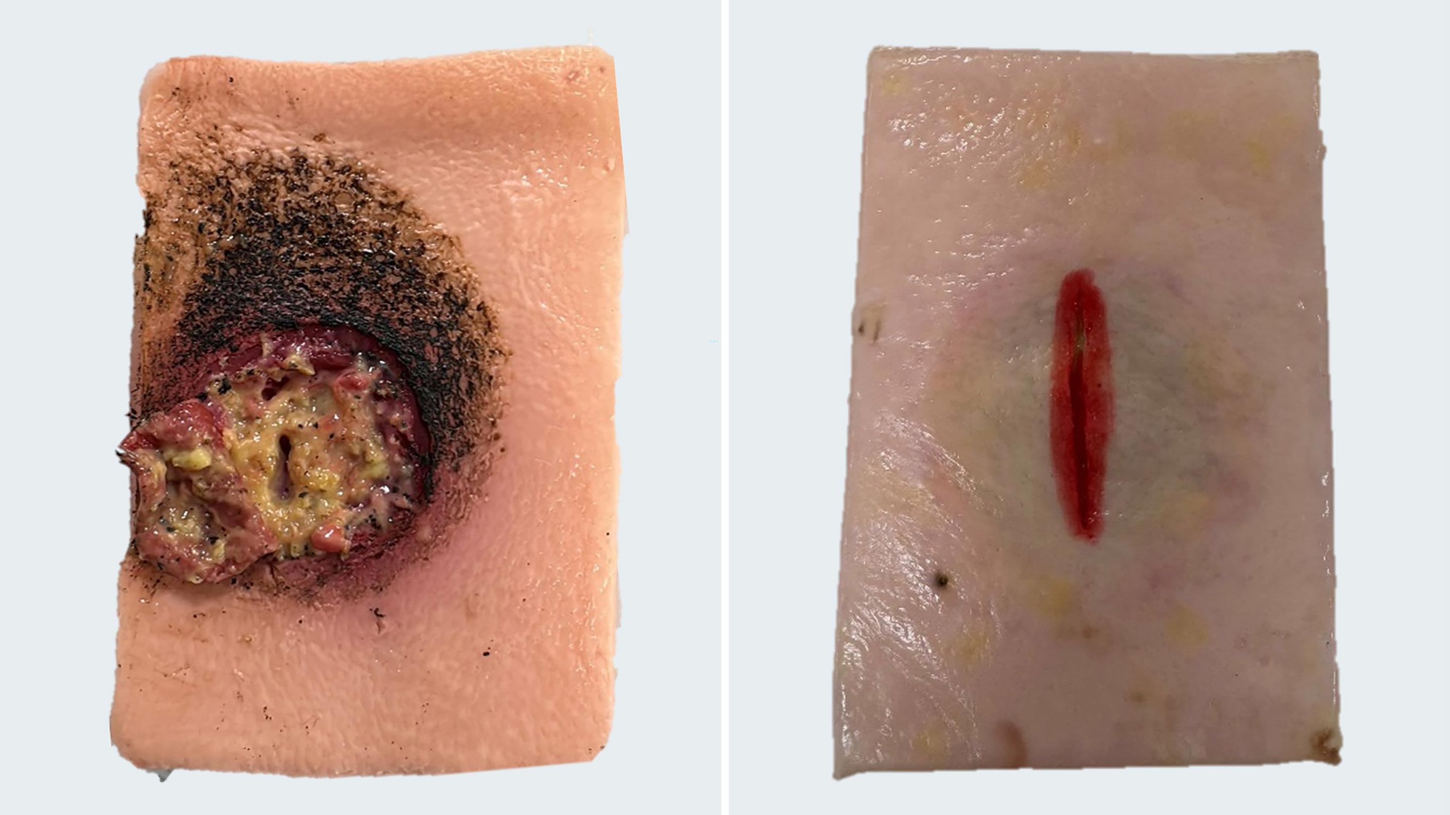 A 3D bioengineered wound model for healthcare training, showing a lifelike pressure ulcer